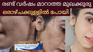 ഒരാഴ്ചക്കുള്ളിൽ remove pimples amp dark spotsമുഖക്കുരു കാരണം ജീവിക്കാൻ വെറുത്തു പോയി😱 [upl. by Yracaz849]