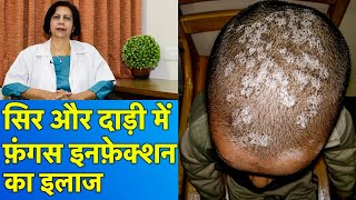 सिर और दाड़ी के फ़ंगस इनफ़ेक्शन का इलाज  Treatment of Fungal Infections In Beard amp Scalp [upl. by Enilekcaj563]