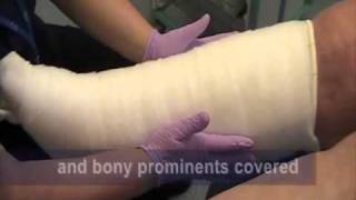 Correct way to apply toe and multilayer bandaging to Lymphoedema patients [upl. by Gilroy]