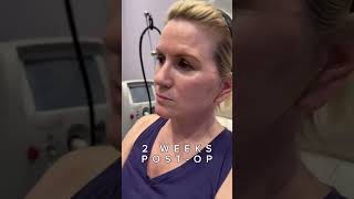 Natural Results  Mini Facelift with Neck Lift  Before amp After [upl. by Kinson151]