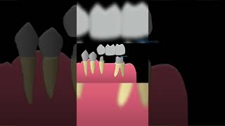 Parts of FPD Fixed Partial Denture  shorts  prosthodontics  dentistry [upl. by Maddeu]