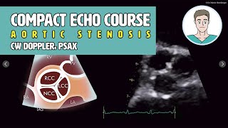 〖Echocardiography〗 Aortic stenosis  CW Doppler 5ChV amp the PSAX 🫀 [upl. by Nolly580]