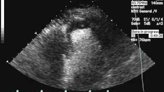 Apical Thrombus [upl. by Neehcas]