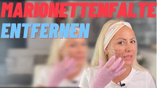 MARIONETTENFALTE mit HIFU entfernen  MERKELFALTE WEG  Ultraschallbehandlung im Selbsttest [upl. by Minnaminnie448]