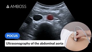 Point of Care Ultrasound of the Abdominal Aorta  AMBOSS Video [upl. by Desmund]