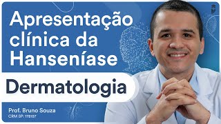 Apresentação clínica da Hanseníase  Dermatologia para Residência Médica e Revalida [upl. by Idolem]