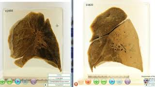 Lobar pneumonia vs Bronchopneumonia [upl. by Buckingham690]