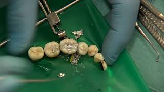 OPERATORIA DENTAL Y ENDODONCIA TÉCNICAS Y MATERIALES4 AMALGAMA DE PLATA CAVIDAD DE CLASE II [upl. by Navek]