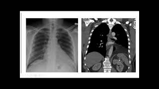 Mediastinal surface of lungs  Relations of mediastinal surface of lungs  Lungs anatomy [upl. by Wenonah]