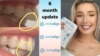 Invisalign Overbite Correction  6 Month UPDATE with before and after pics [upl. by Naujet]