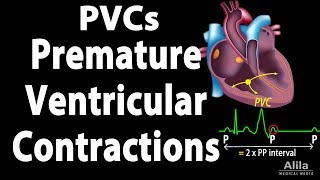 Premature Ventricular Contractions PVCs Animation [upl. by Danyette]