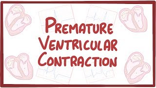 Premature Ventricular Contraction  causes symptoms diagnosis treatment pathology [upl. by Estey]