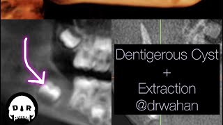 Dentigerous Cyst Removal with Extraction of Involved Impacted Molar drwahan [upl. by Lenny]