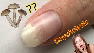 I Got ONYCHOLYSIS amp My Nail is LIFTING OFF   Nail Injury [upl. by Okika]