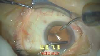 Katarakt Ameliyatı  Alcon UltraSert IOL  Cataract Surgery  Unedited Video  Prof Dr Hüseyin Yetik [upl. by Ardnnaed]