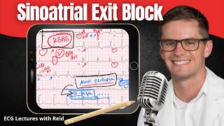 Sinoatrial SA Exit Block EKG  ECG Lecture [upl. by Trill328]