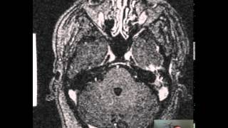 Mastoiditis Brain Abscess DISCUSSION [upl. by Tnecniv]