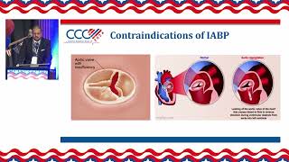 Asif Shaikh RCIS Impella Intra aortic Balloon Pump IABP and Hemodynamic Support Key Considerat [upl. by Giarg]