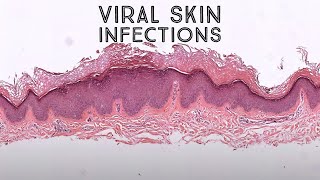 Viral Skin Infections amp Mimics Board Review for Dermpath Dermatology Pathology [upl. by Geri]