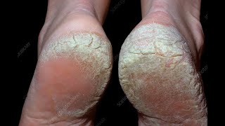 Palmoplantar Psoriasis Dos amp Donts  உள்ளங்கால் சொரியாசிஸ் சவால்  Dr Selvin [upl. by Robina577]