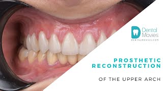 Prosthetic reconstruction of the upper arch [upl. by Law156]