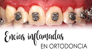 ENCÍAS INFLAMADAS CON ORTODONCIA  CAUSAS Y TRATAMIENTO [upl. by Noraf86]