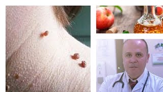 اسرع علاج منزلي طبيعي وفعال للتخلص من الزوائد الجلديه SKIN TAGS REMOVAL [upl. by Sclar]