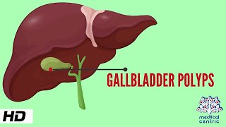 Gallbladder Polyp Causes Signs and Symptoms Diagnosis and Treatment [upl. by Seale655]