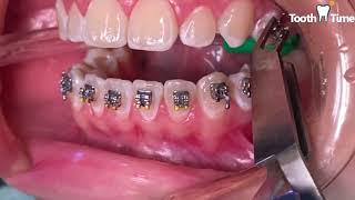 How they put braces on  13 years old patient  Tooth Time Family Dentistry New Braunfels Texas [upl. by Aniroz]