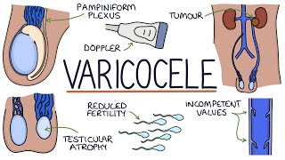 Varicoceles [upl. by Mota]