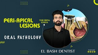 periapical lesions  granuloma and abscess  oral pathology  عزت شومان [upl. by Ailehpo]