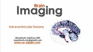 Imaging of intraventricular lesions DRE Prof Mamdouh Mahfouz [upl. by Rosenstein]