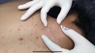 ACNE TREATMENT WITH VU QUYNH MI  Acne on Back amp Chest 2023p1 [upl. by Latt]