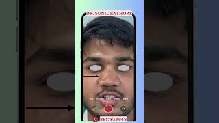 Rhinoplasty  Nose Job bhopal cosmeticsurgery plasticsurgery [upl. by Keriann447]