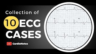 Collection of 10 ECG Cases with Answers EKG Cardiology Heart [upl. by Aitnecserc]