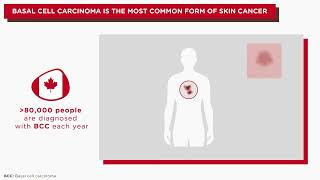 Helping You Understand Basal Cell Carcinoma BCC [upl. by Sueddaht792]