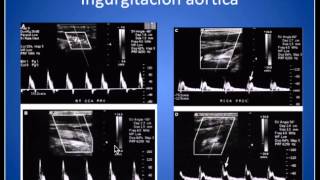 Analisis Onda Espectral Arterias Carótidas y Vertebrales [upl. by Heins381]