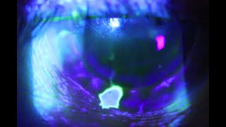 A positive Seidels Test or the corneal waterfall sign [upl. by Tanney]