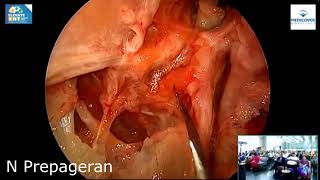 Module 5 Endoscopic Vidian Canal Meckels Cave and Lateral Sphenoid Recess Exposure of Skull Base [upl. by Aksel]