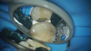 Teflon Floss on premolar [upl. by Nelda]