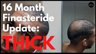 16 Month Before and After Finasteride Update [upl. by Nymsaj]