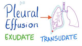 Pleural Effusion  Transudate or Exudate  Causes and Liddle’s Criteria Pulmonary Medicine Playlist [upl. by Elehcor]