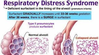 أوضح شرح لل Respiratory distress syndrome RDS in newborn في الأطفال [upl. by Trici]