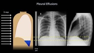 How to Interpret a Chest XRay Lesson 6  Diaphragm and Pleura [upl. by Utimer439]