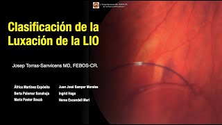 Clasificación de la Luxación de la Lente Intraocular [upl. by Dolora]