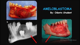 Ameloblastoma Etiología Características  Clínicas Radiográficas Histológicas y Tratamiento [upl. by Bultman]