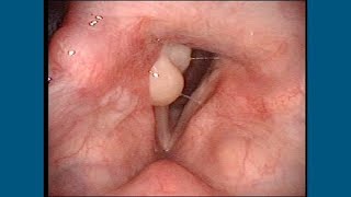 Post Intubation Arytenoid Granuloma [upl. by Nevin]