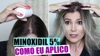 COMO APLICAR MINOXIDIL  NÃO RESSECA O CABELO [upl. by Mignonne]