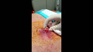 HD Graphic Step by Step Abscess and Infected Lipoma Drainage Medical Education amp Training [upl. by Vokaay]