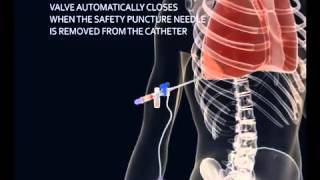 How to make a Thoracentesis pleural puncture with Pleura safe [upl. by Tare]